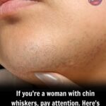 Understanding and Managing Chin Whiskers in Women: Causes, Impact & Solutions