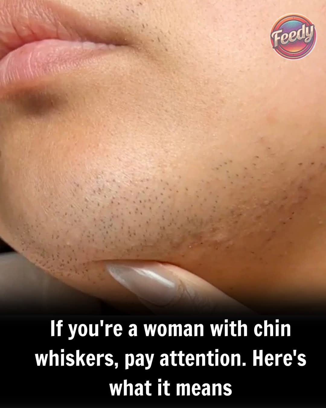 Understanding and Managing Chin Whiskers in Women: Causes, Impact & Solutions